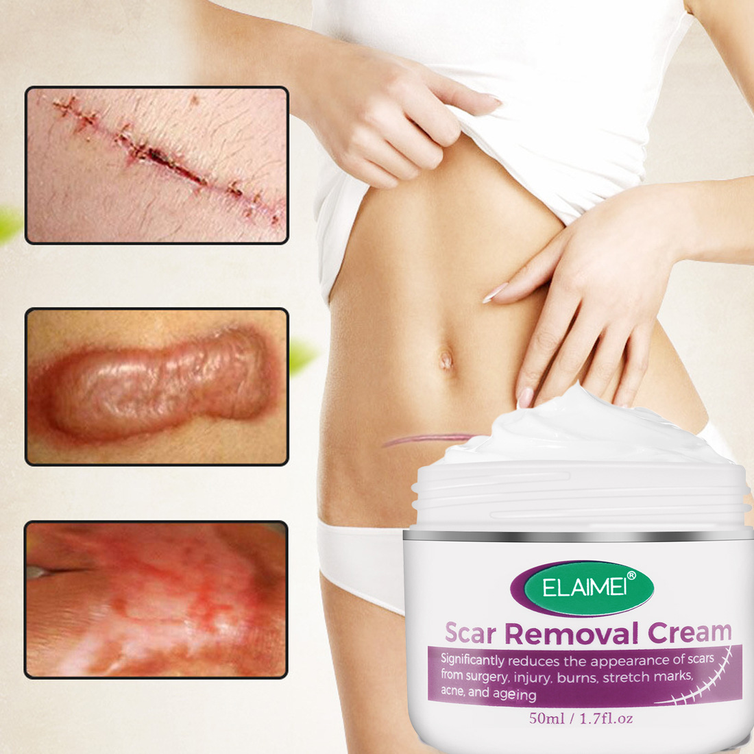 Scar Removal, Stretch Marks Cream