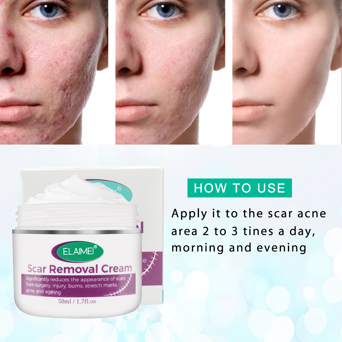 Scar Removal, Stretch Marks Cream