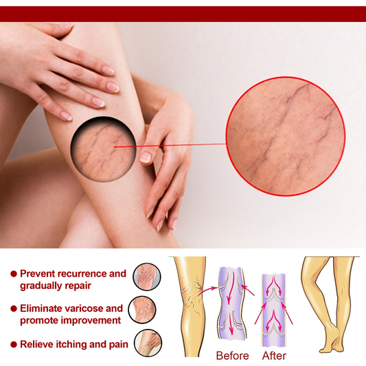 Varicose Veins Treatment Cream