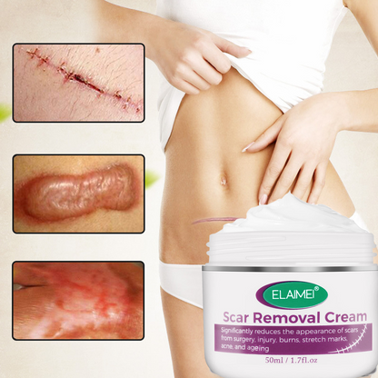 Scar Removal, Stretch Marks Cream